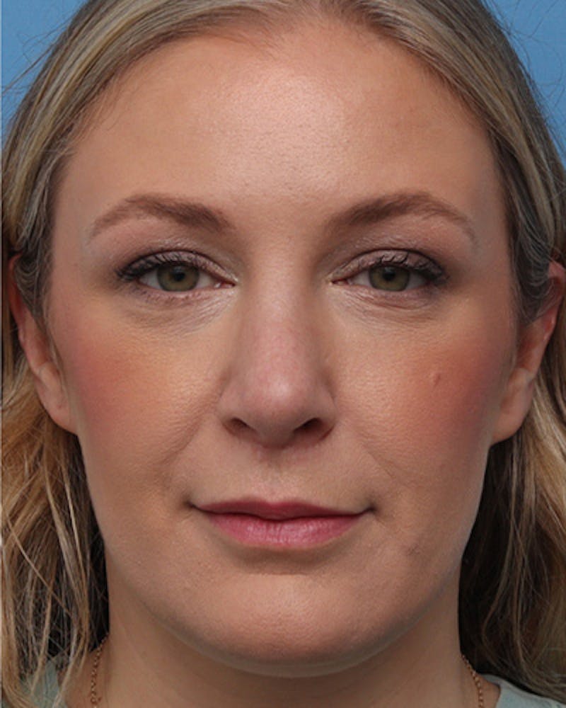 Rhinoplasty Before & After Gallery - Patient 151394 - Image 4