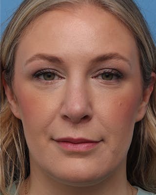 Rhinoplasty Before & After Gallery - Patient 313285 - Image 4