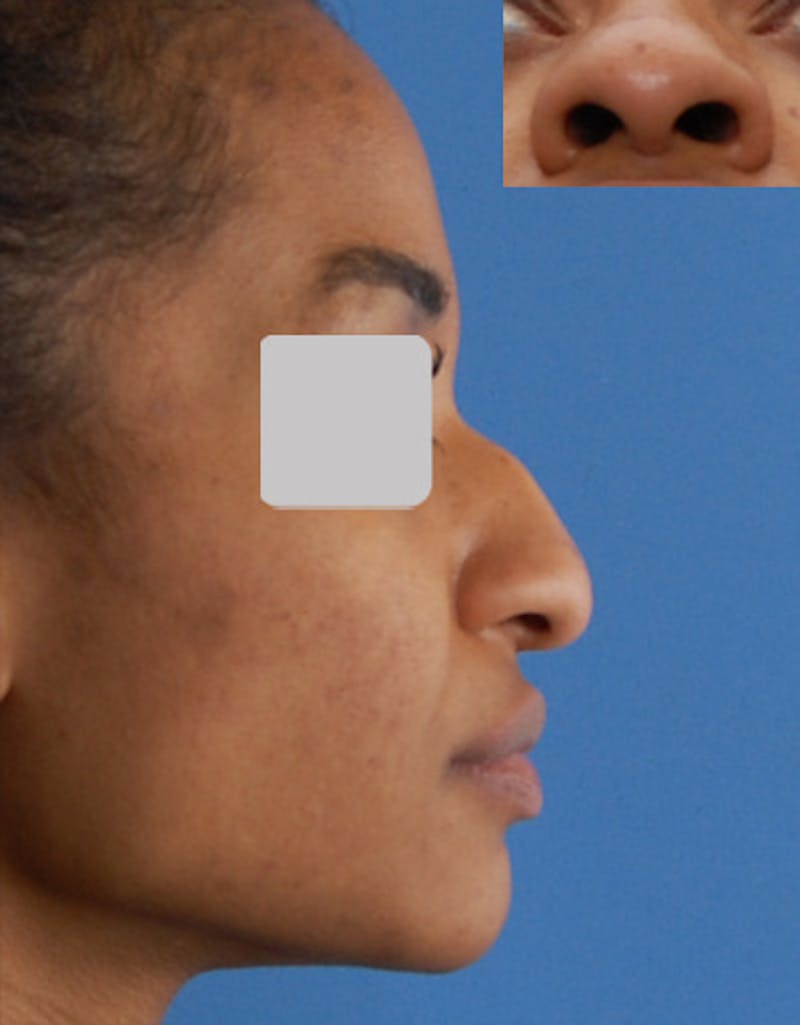 Ethnic Rhinoplasty Before & After Gallery - Patient 357129 - Image 1