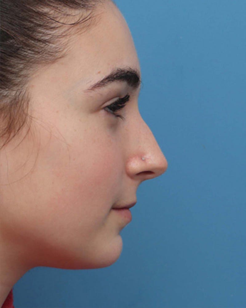 Rhinoplasty Before & After Gallery - Patient 391175 - Image 1