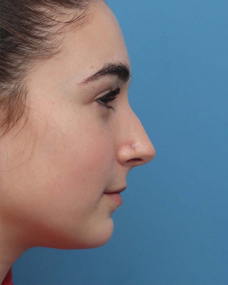 Patient QWqUfFFTTQeU9BJPTQl0Sg - Rhinoplasty Before & After Photos
