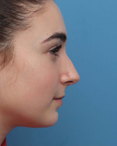 Rhinoplasty Before & After Gallery - Patient 221343 - Image 1