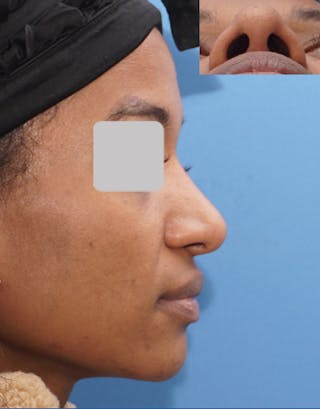 Favorite Ethnic Rhinoplasty Before & After Gallery - Patient 309524 - Image 2