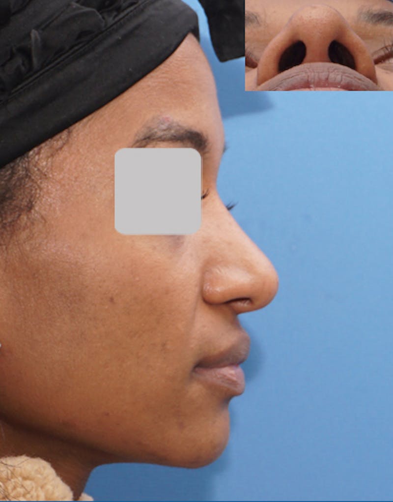 Ethnic Rhinoplasty Before & After Gallery - Patient 357129 - Image 2