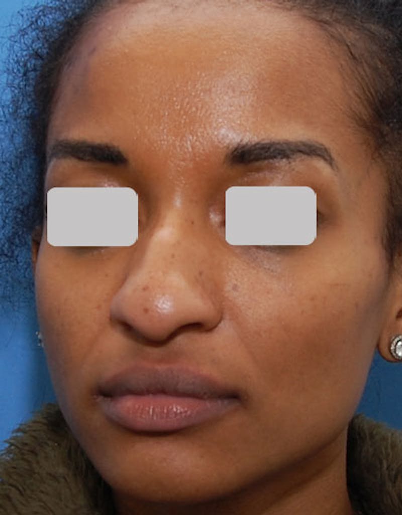 Ethnic Rhinoplasty Before & After Gallery - Patient 357129 - Image 3