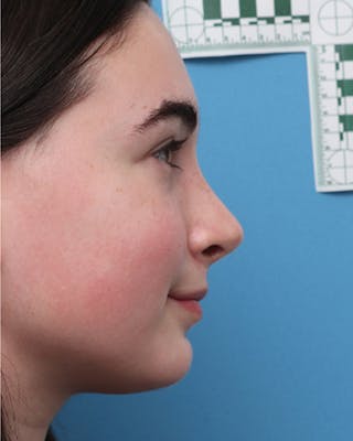 Rhinoplasty Before & After Gallery - Patient 221343 - Image 2