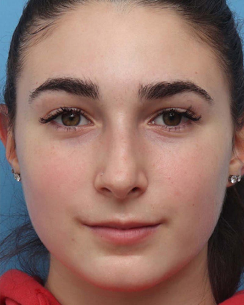 Rhinoplasty Before & After Gallery - Patient 391175 - Image 3