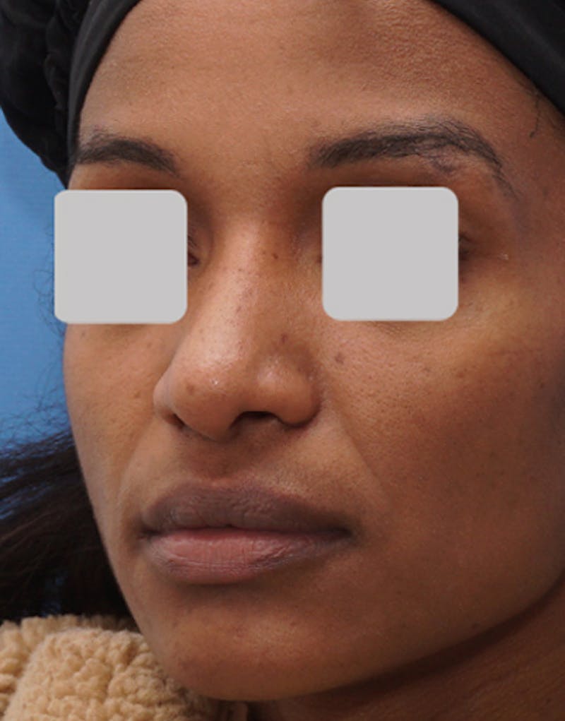 Ethnic Rhinoplasty Before & After Gallery - Patient 357129 - Image 4
