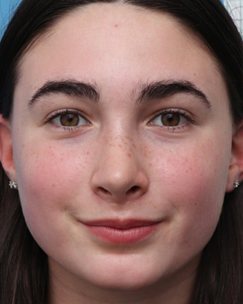 Rhinoplasty Before & After Gallery - Patient 391175 - Image 4