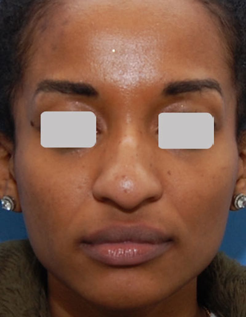 Ethnic Rhinoplasty Before & After Gallery - Patient 357129 - Image 5