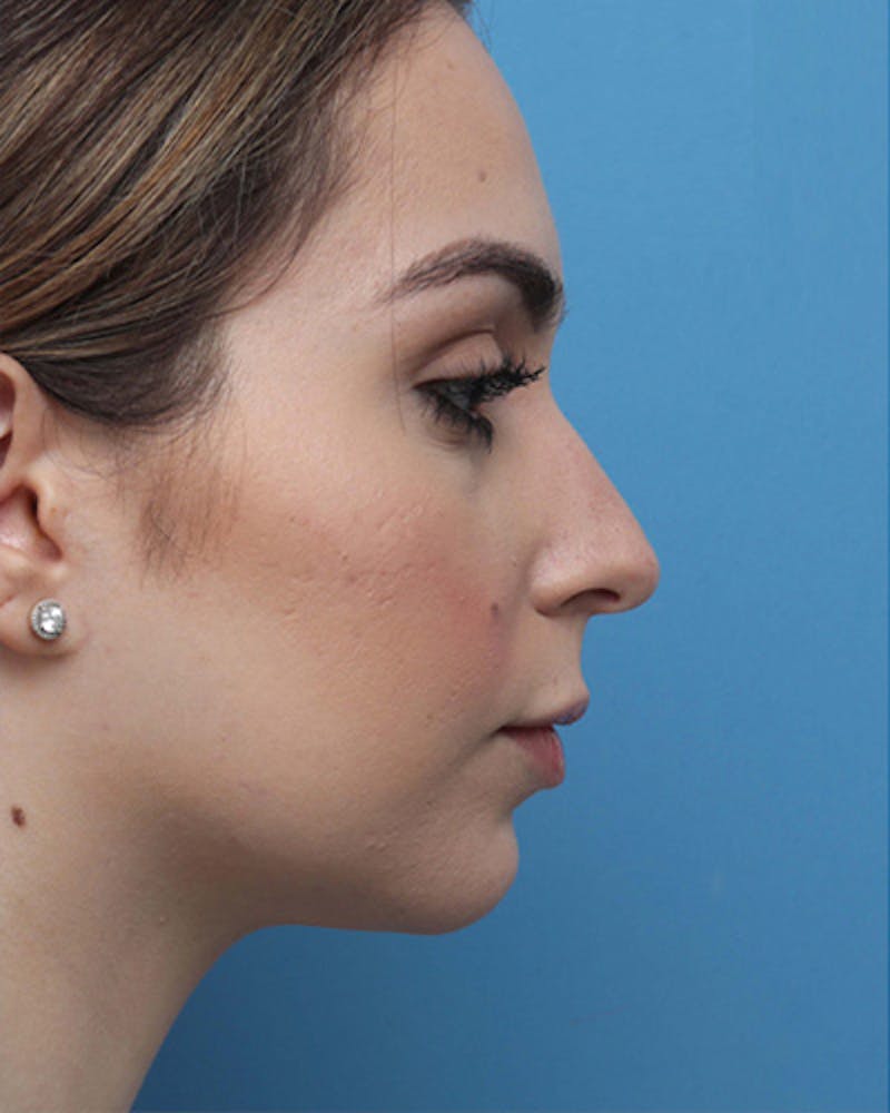 Patient ZJCR1KICReyQIUTskRpMWg - Rhinoplasty Before & After Photos