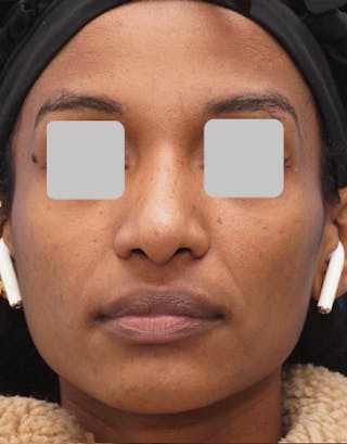 Favorite Ethnic Rhinoplasty Before & After Gallery - Patient 309524 - Image 6