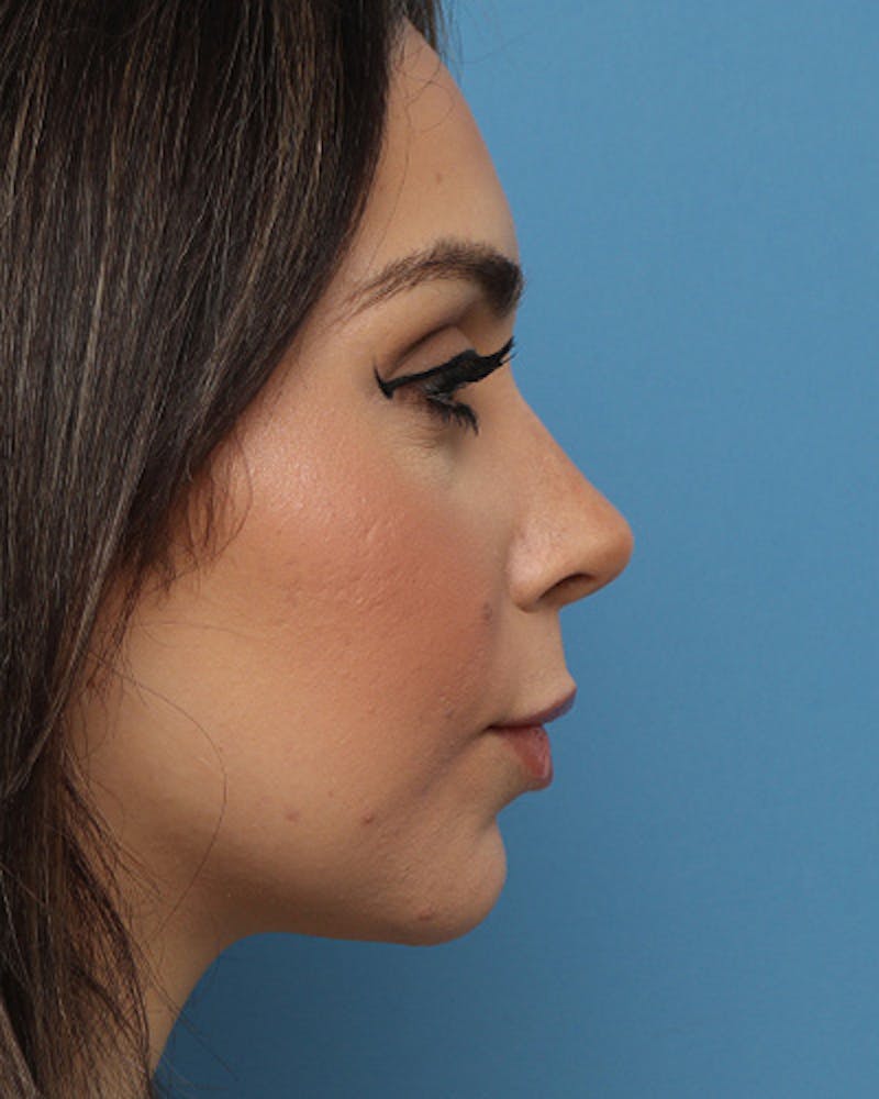 Rhinoplasty Before & After Gallery - Patient 324970 - Image 2