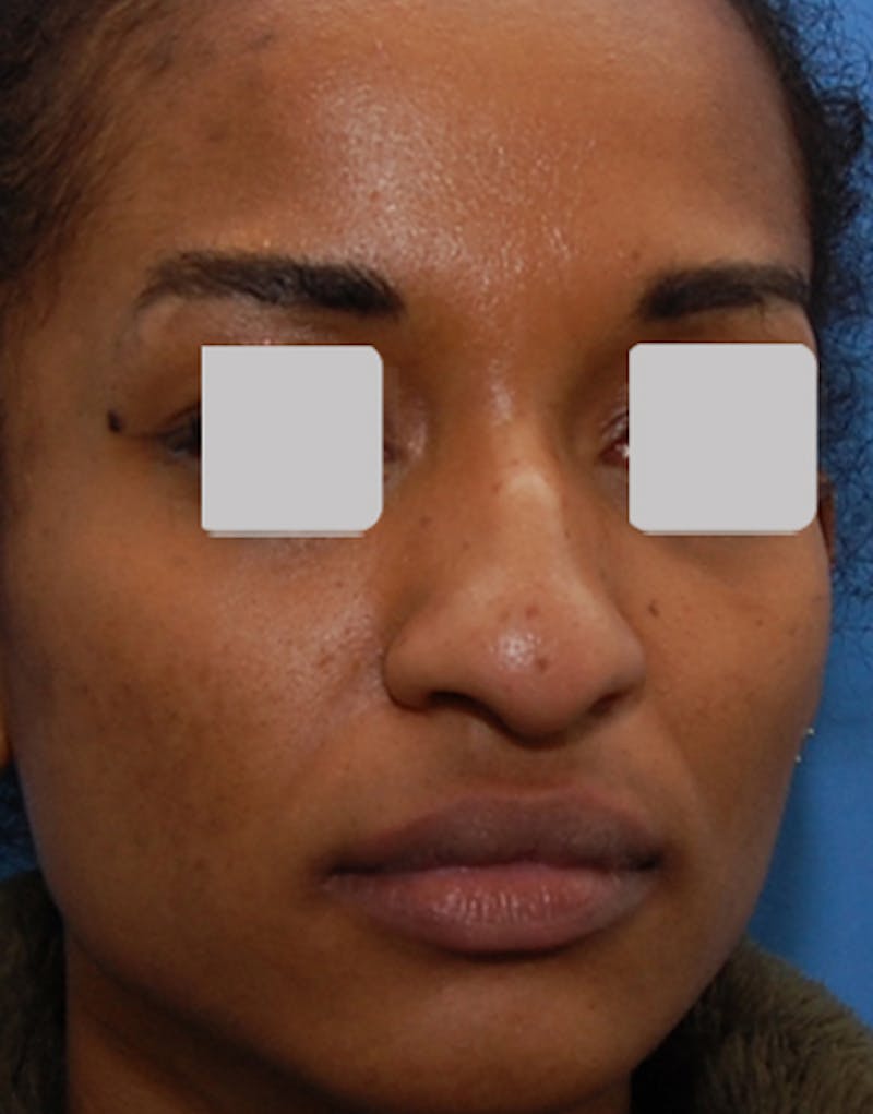 Ethnic Rhinoplasty Before & After Gallery - Patient 357129 - Image 7