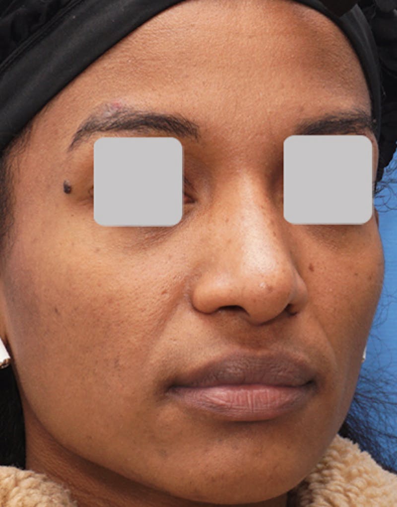 Ethnic Rhinoplasty Before & After Gallery - Patient 357129 - Image 8