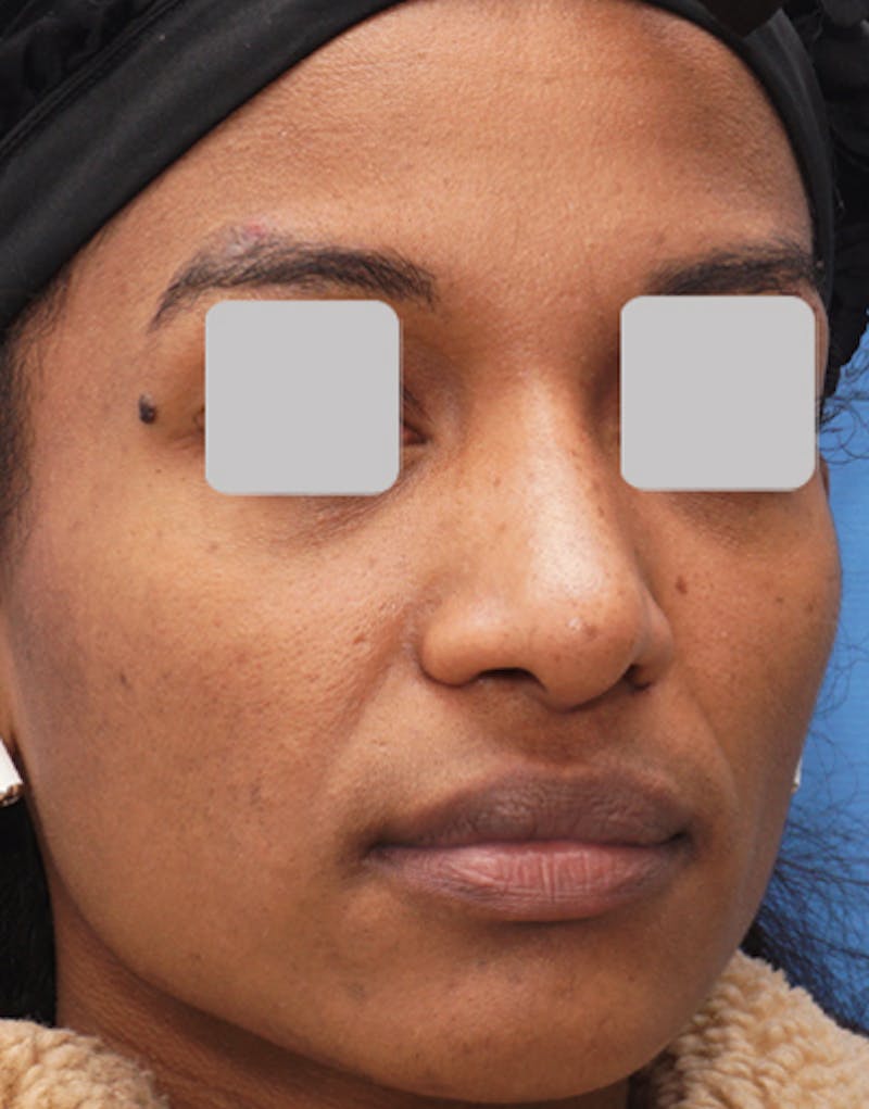 Rhinoplasty  Before & After Gallery - Patient 206086 - Image 8