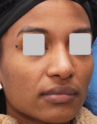 Favorite Ethnic Rhinoplasty Before & After Gallery - Patient 309524 - Image 8