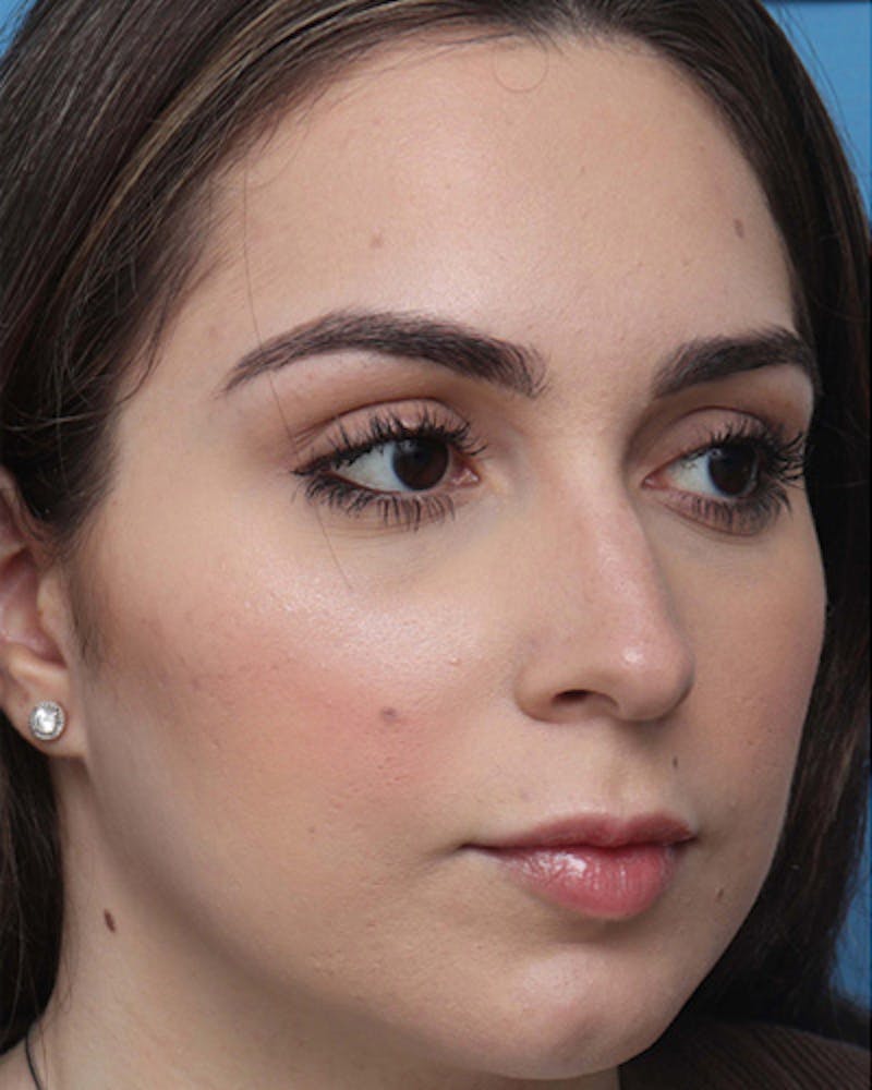 Rhinoplasty Before & After Gallery - Patient 324970 - Image 3