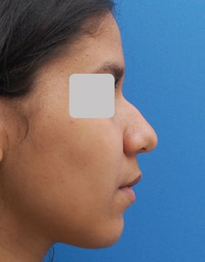 Favorite Ethnic Rhinoplasty Before & After Gallery - Patient 183409 - Image 1