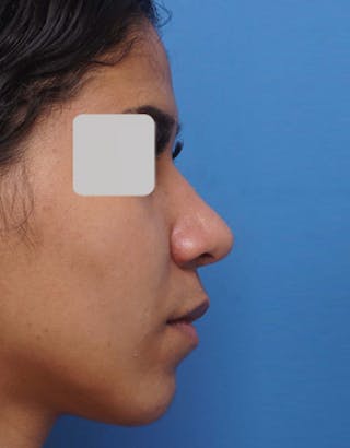 Favorite Ethnic Rhinoplasty Before & After Gallery - Patient 183409 - Image 2