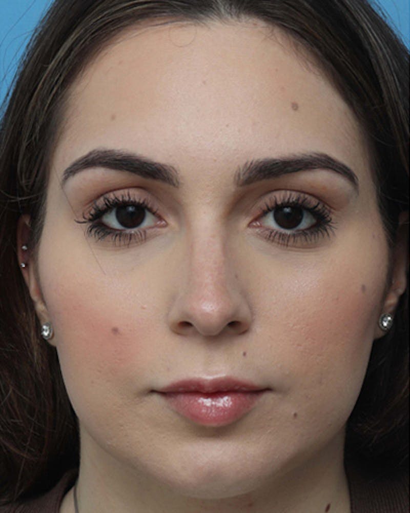 Rhinoplasty Before & After Gallery - Patient 324970 - Image 5