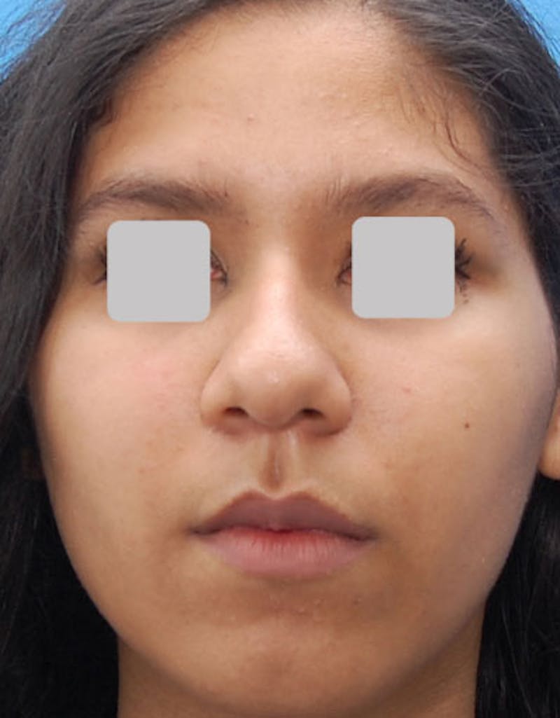 Ethnic Rhinoplasty Before & After Gallery - Patient 202758 - Image 3