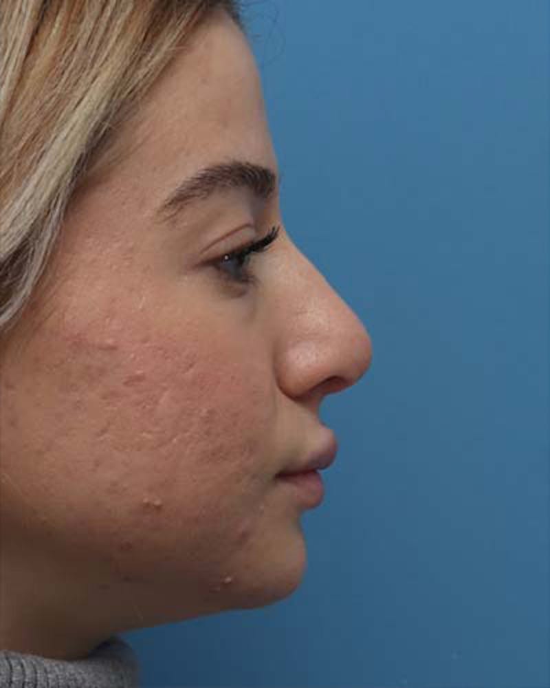 Patient VW5r7vtiThiOeB1FRvKJsg - Rhinoplasty Before & After Photos