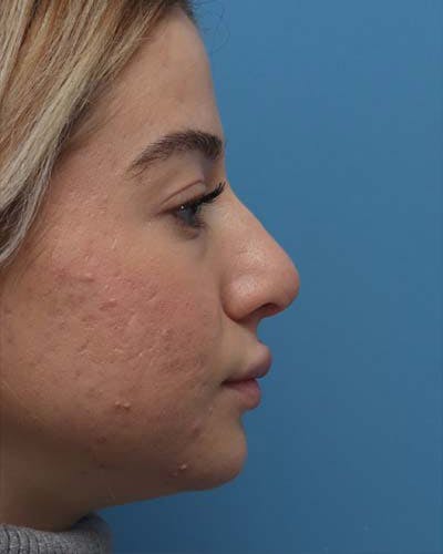 Rhinoplasty Before & After Gallery - Patient 392987 - Image 1