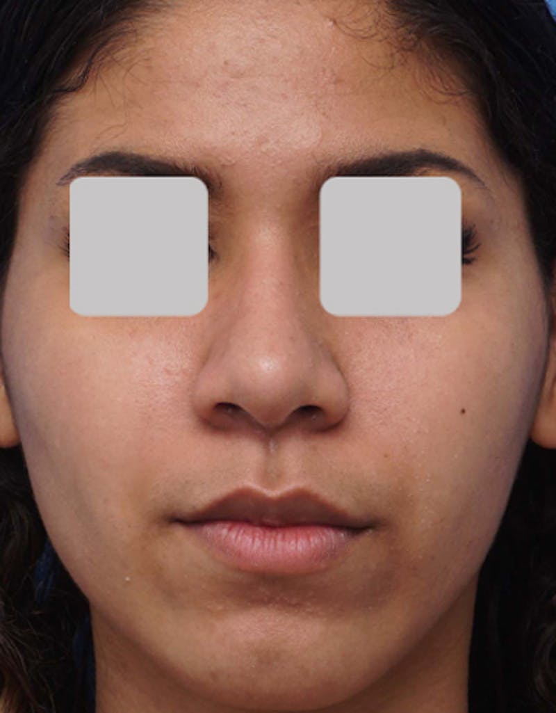 Ethnic Rhinoplasty Before & After Gallery - Patient 202758 - Image 4