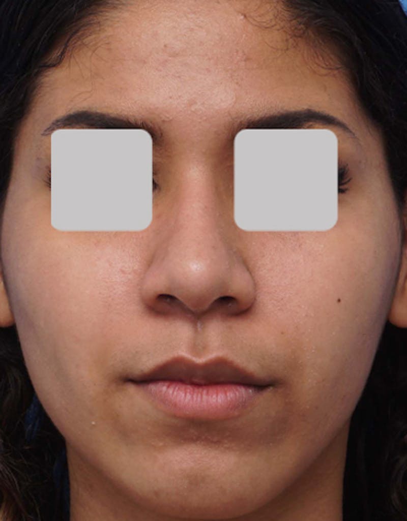 Rhinoplasty  Before & After Gallery - Patient 284824 - Image 4