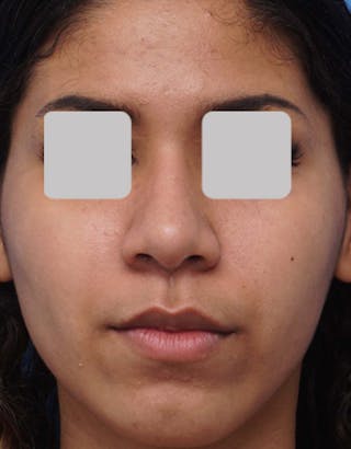Favorite Ethnic Rhinoplasty Before & After Gallery - Patient 183409 - Image 4