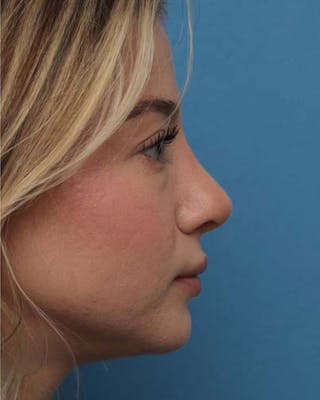 Rhinoplasty Before & After Gallery - Patient 392987 - Image 2