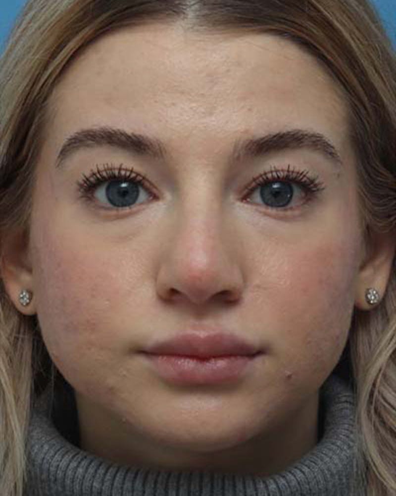 Rhinoplasty  Before & After Gallery - Patient 392987 - Image 3