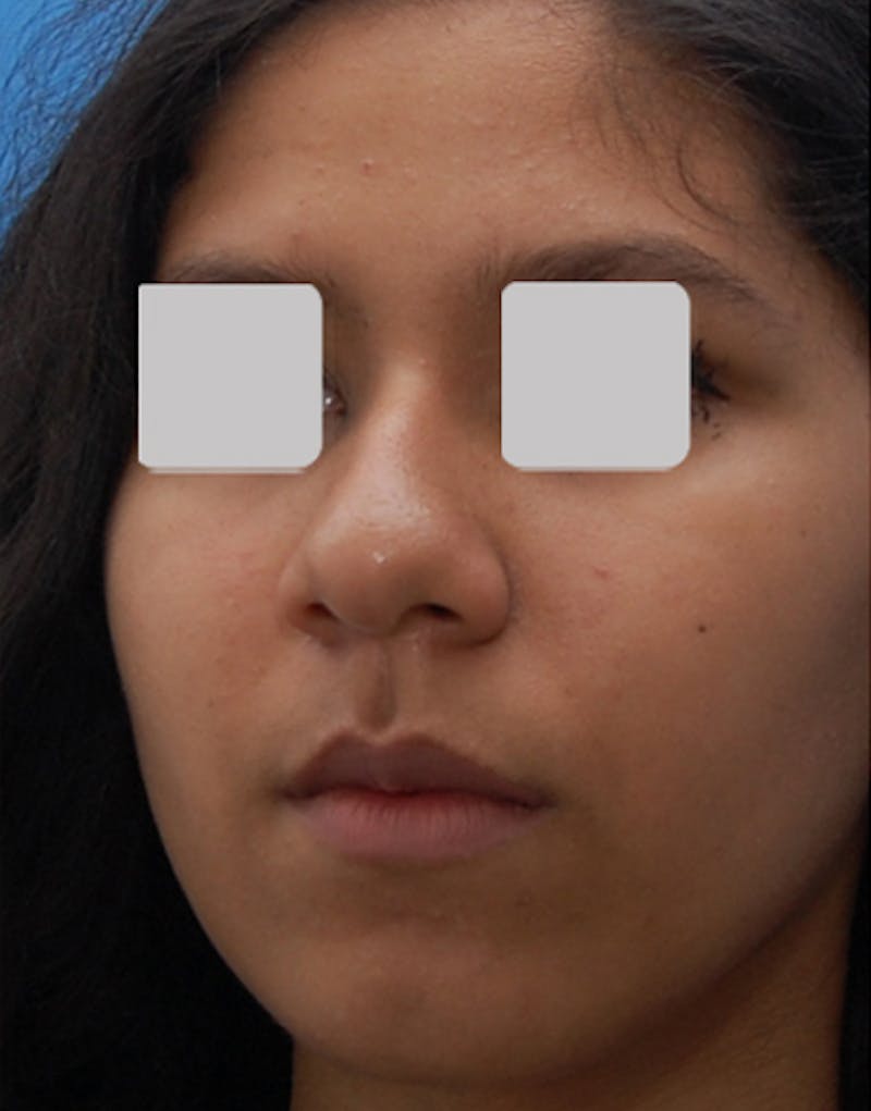 Ethnic Rhinoplasty Before & After Gallery - Patient 202758 - Image 5