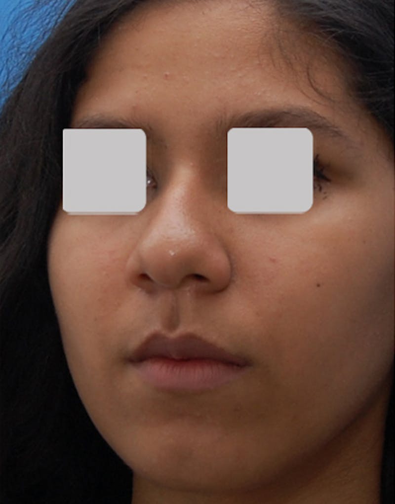 Rhinoplasty  Before & After Gallery - Patient 284824 - Image 5