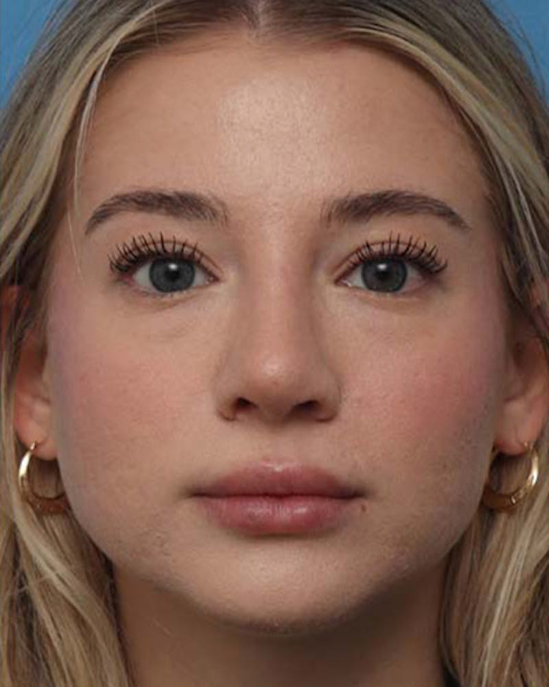 Rhinoplasty  Before & After Gallery - Patient 392987 - Image 4