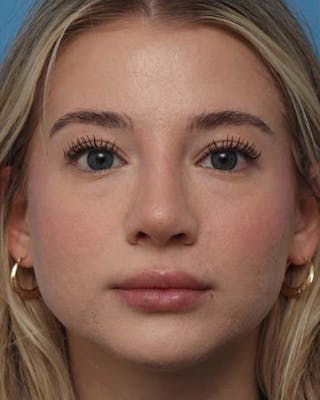 Rhinoplasty Before & After Gallery - Patient 392987 - Image 4
