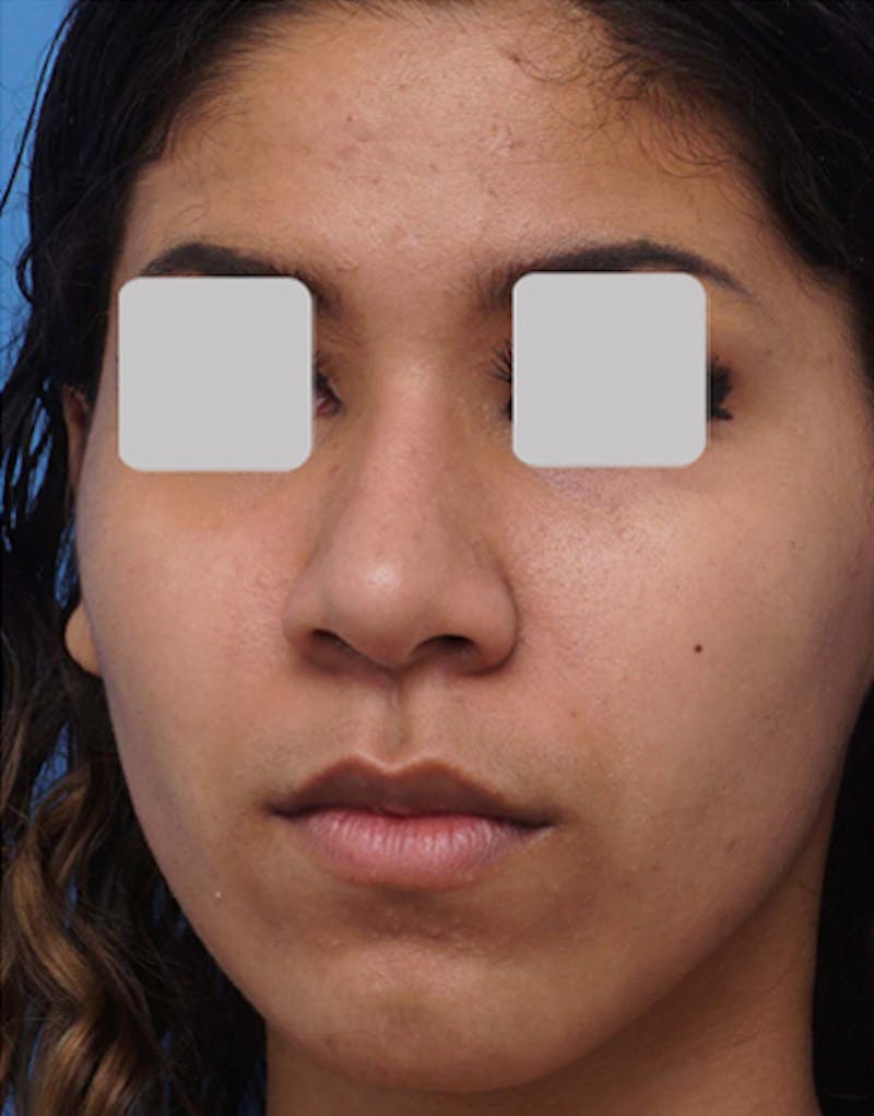 Ethnic Rhinoplasty Before & After Gallery - Patient 202758 - Image 6
