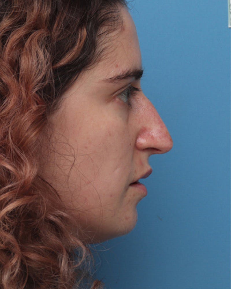 Rhinoplasty Before & After Gallery - Patient 209929 - Image 1