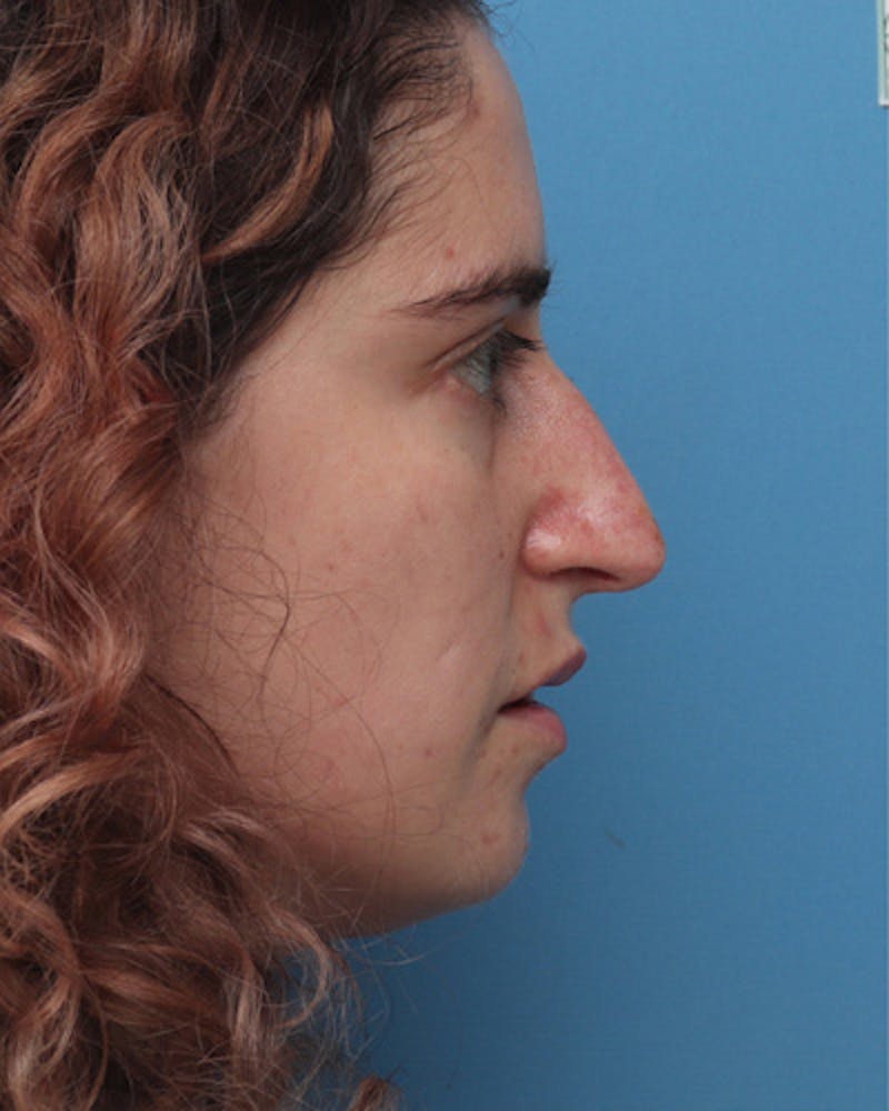 Patient HIj2bF5XQX63Je8PSR34NA - Rhinoplasty Before & After Photos