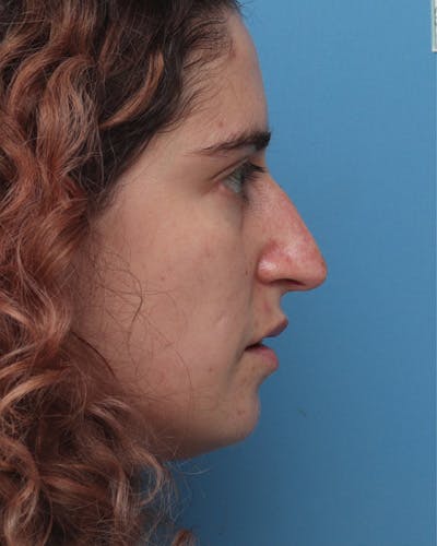 Rhinoplasty Before & After Gallery - Patient 136149 - Image 1