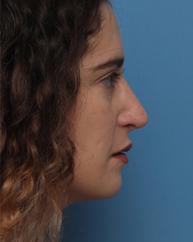 Rhinoplasty Before & After Gallery - Patient 209929 - Image 2