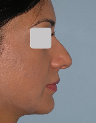 Favorite Ethnic Rhinoplasty Before & After Gallery - Patient 109656 - Image 1