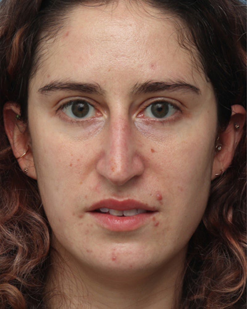 Rhinoplasty Before & After Gallery - Patient 209929 - Image 3