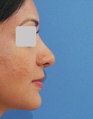 Favorite Ethnic Rhinoplasty Before & After Gallery - Patient 109656 - Image 2