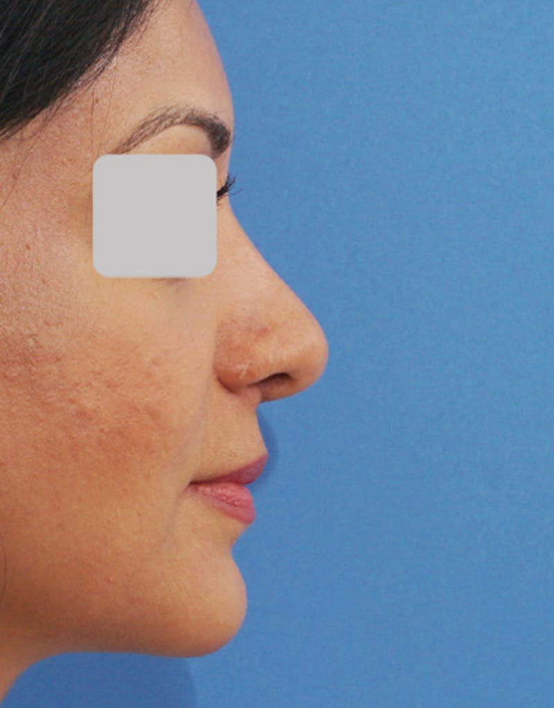 Ethnic Rhinoplasty Before & After Gallery - Patient 305791 - Image 2