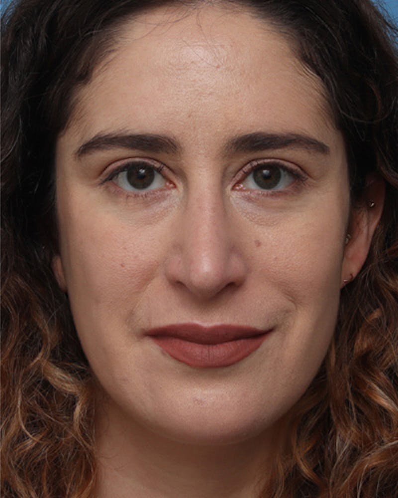 Rhinoplasty  Before & After Gallery - Patient 136149 - Image 4