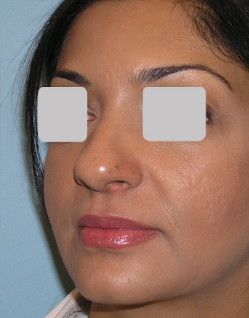 Ethnic Rhinoplasty Before & After Gallery - Patient 305791 - Image 3