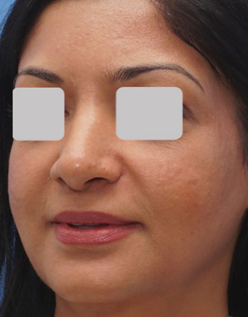 Ethnic Rhinoplasty Before & After Gallery - Patient 305791 - Image 4