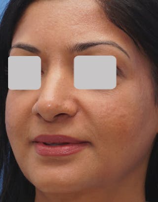 Favorite Ethnic Rhinoplasty Before & After Gallery - Patient 109656 - Image 4
